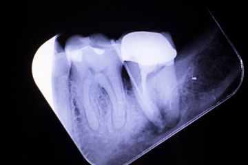 Análisis Micro–Tomográfico Morfológico de Premolares Mandibulares con Tres Canales Radiculares