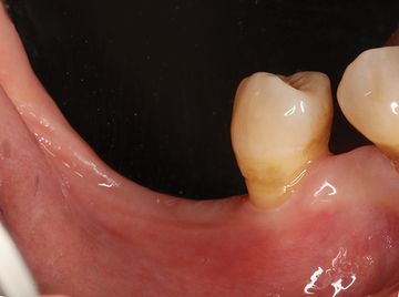 Overcoming anatomical formations in implantology