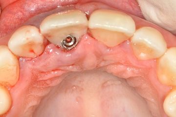 Implantación inmediata utilizando la corona extraída.