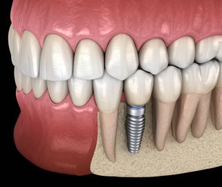 Crestal Sinuslift mit einem Implantat mit internem L-förmigem Kanal: Ergebnisse nach 1 Jahr nach der Belastung aus einer prospektiven Kohortenstudie Crestal Sinuslift mit einem Implantat mit internem L-förmigem Kanal: Ergebnisse nach 1 Jahr nach der Belastung aus einer prospektiven Kohortenstudie