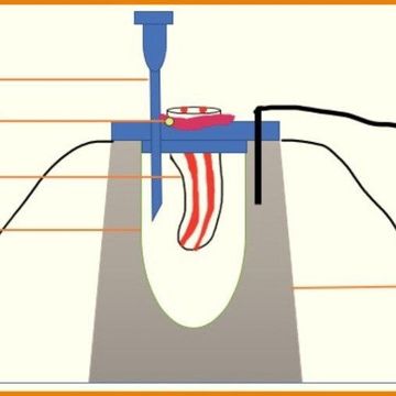 Einfluss der klinischen operativen Technik auf die Debris-Extrusion von zwei reziproken Feilen