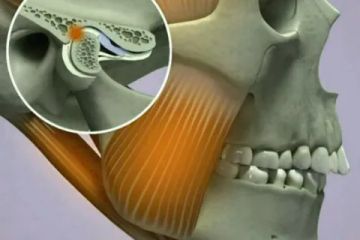 Costen's Syndrome