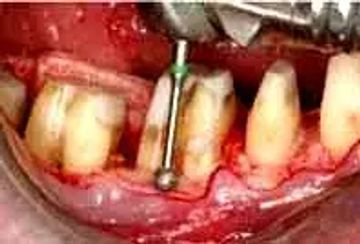 Combining perio-restorative protocols to maximize function