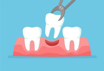 Autotransplantation of Teeth