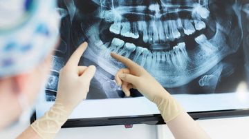 Unicystic ameloblastoma: a possible pitfall in periapical diagnosis
