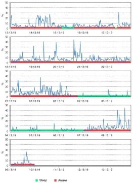 Current Knowledge and Future Perspectives on Awake Bruxism Assessment: Expert Consensus Recommendations 