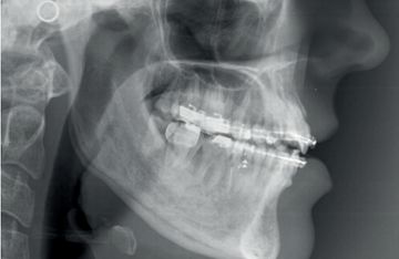 Syndrom der Schmerzen bei temporomandibulärer Dysfunktion. Kieferorthopädische Chirurgie
