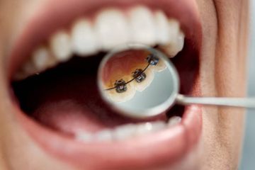 Orthodontics and Mandibular Orthognathic Surgery
