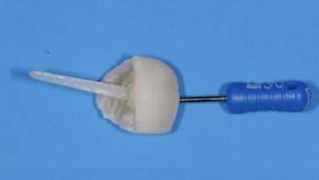 Fractura de la corona dental. Uso del fragmento roto