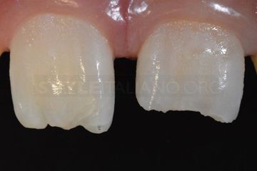 Treatment of Crown Fractures within Enamel and Dentin