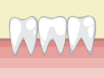 Micro-CT analysis of danger zone thickness in the mesiobuccal roots of maxillary first molars