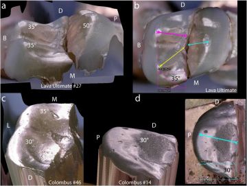 Fractography of Clinical Failures of Indirect Resin Composite Endocrown and Overlay Restorations