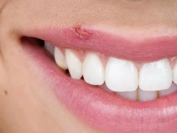 Precancerous diseases of the oral mucosa
