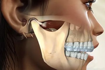 Nicht-odontogene, nicht-osteogene Tumoren des Kiefers