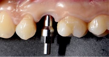 Implant Fracture: A Narrative Literature Review