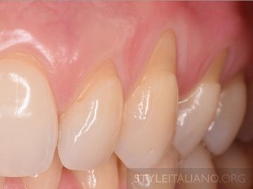 Increased dentin sensitivity