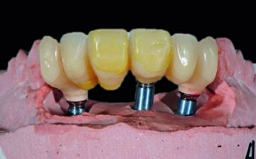 Injectable silicone-based gingival mask technique: Transferring the emergence profile of multiple implant restorations 
