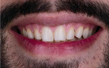 Digital und analog – der Einfluss der Technologie auf feldspatbasierte Veneers