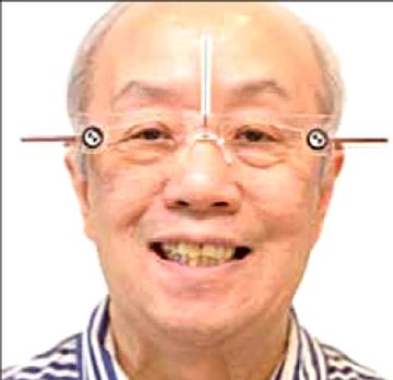 Facial Analysis for the Digital Planning of a Full-Mouth Implant Rehabilitation 