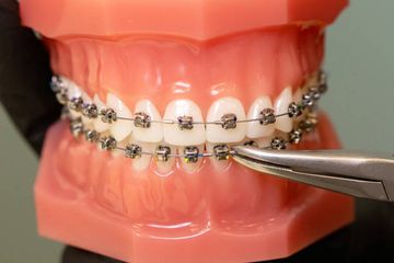 Bimaxillary advancement with aesthetic and functional improvement