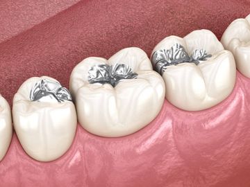 Pit and Fissure Sealants: Preventive Measures for Occlusal Caries