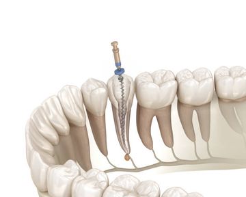 Stress Analysis through Finite Element Study in Teeth Reconstructed with Post and Core and Crown