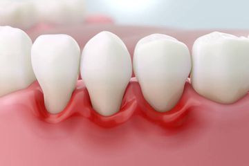 Periodontal Disease and Age-Related Maculopathy: A Case Report