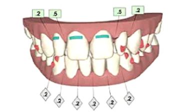 Merging Clear Aligner Therapy With Digital Smile Design to Maximize Esthetics and Minimize Tooth Reduction
