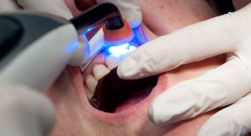 Außergewöhnliches Knochenumbau über Kompositrestauration bei der Behandlung von externer Wurzelresorption: Ein Fallbericht