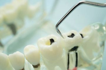 Reendodontische Nachbehandlung mit apikaler radikulärer Perforation des Zahns 11: akademischer wissenschaftlicher Fallbericht.