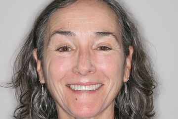 Treatment of a Patient with Progressive Periodontal Disease