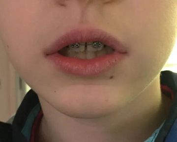 A Simplified Approach to Rehabilitation of Swallowing: Labiotherapy 
