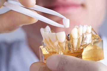 Обработанные и литые абатменты для одиночных зубных имплантатов: 5-летнее многоцентровое рандомизированное контролируемое исследование внутри пациента