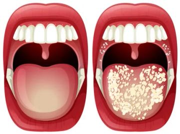 Manifestations of mycoses in the oral cavity. Candidal stomatitis