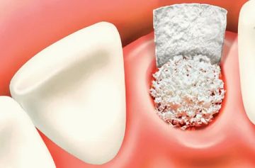 Operações de retalho. Materiais para osteogingivoplastia