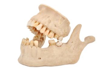 Prevalence of Elongated Ossified Styloid Process and Eagle Syndrome in the Population Attending the Orthodontics Clinic of CEDHUM