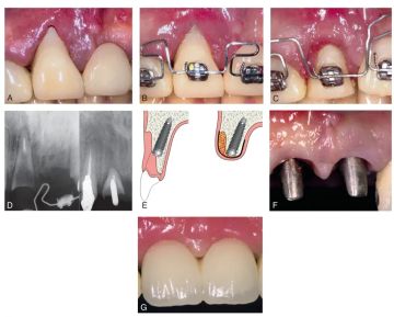 Periodontal considerations