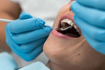 Oral Leukoplakia: Etiology, Diagnosis, Clinical Features and Treatment