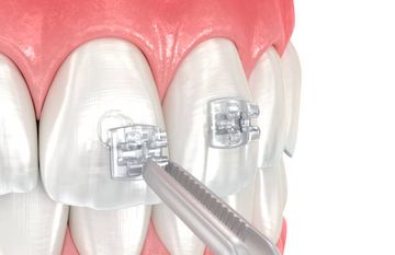 Die lateralen mandibulären Abweichungen, funktionell und skelettal. Ihre Lösung durch funktionelle Orthopädie.