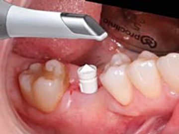 Capítulo XX. Flujo digital: La provisionalización sobre implantes 