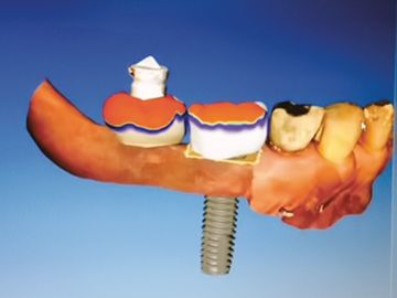 CAD/CAM Technology for Restoration of Lower Jaw Teeth