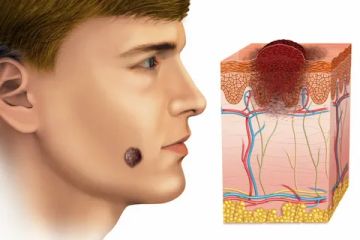Skin melanoma