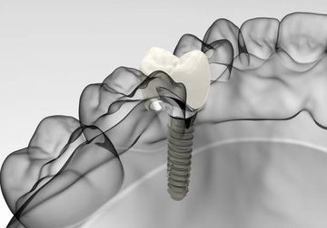 Nuevo flujo de trabajo digital para rehabilitación de arco completo
