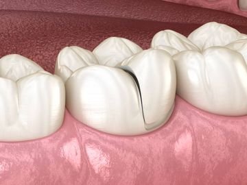 Microfessure dentinali radicolari: un fenomeno sperimentale post-estrazione?