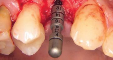 Delayed immediate implantation with volume-stable augmentation