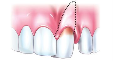 Dental trauma. Diagnosis and treatment