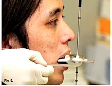 Digital Smile Design Meets the Dento-Facial Analyzer: Optimizing Esthetics While Preserving Tooth Structure  
