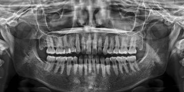Diagnostische Bedeutung der digitalen Volumentomographie bei der Erkennung einer vestibulären Wurzelperforation: Klinischer Fall