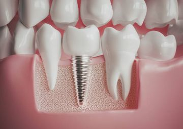 Impresión digital sobre implantes: ¿qué es lo que tenemos que saber?