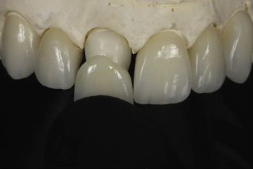 Adhesion and Optics: The Challenges of Esthetic Oral Rehabilitation on Varied Substrates - Reflections Based on a Clinical Report